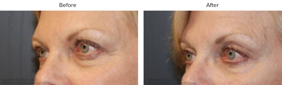 Blepharoplasty (Eyelid Surgery) Before & After Gallery - Patient 465660 - Image 2