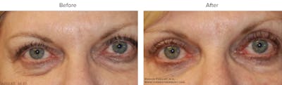 Blepharoplasty (Eyelid Surgery) Before & After Gallery - Patient 465660 - Image 1