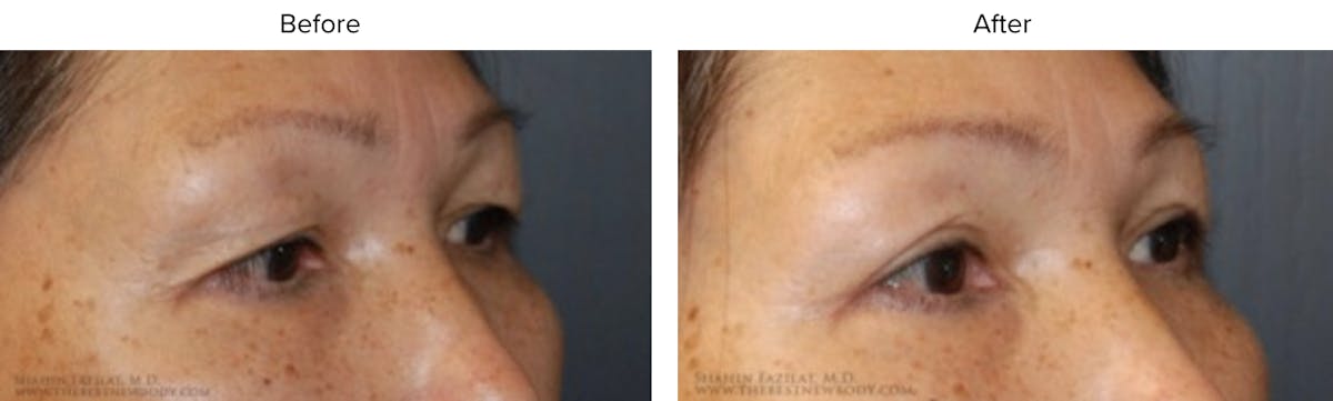 Blepharoplasty (Eyelid Surgery) Before & After Gallery - Patient 371543 - Image 1