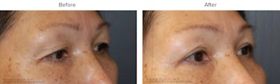 Blepharoplasty (Eyelid Surgery) Before & After Gallery - Patient 371543 - Image 1