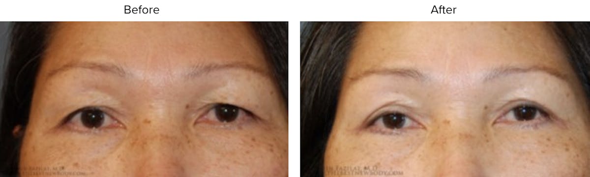 Blepharoplasty (Eyelid Surgery) Before & After Gallery - Patient 371543 - Image 2