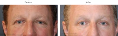 Blepharoplasty (Eyelid Surgery) Before & After Gallery - Patient 885769 - Image 1