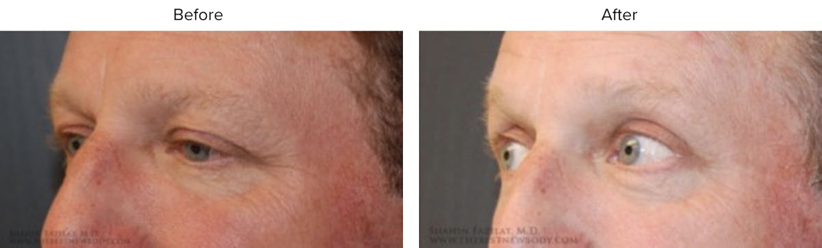 Blepharoplasty (Eyelid Surgery) Before & After Gallery - Patient 885769 - Image 2