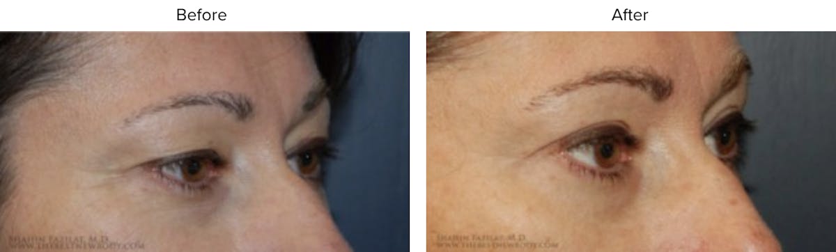 Blepharoplasty (Eyelid Surgery) Before & After Gallery - Patient 199833 - Image 2