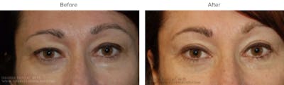 Blepharoplasty (Eyelid Surgery) Before & After Gallery - Patient 199833 - Image 1