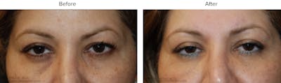 Blepharoplasty (Eyelid Surgery) Before & After Gallery - Patient 258042 - Image 1