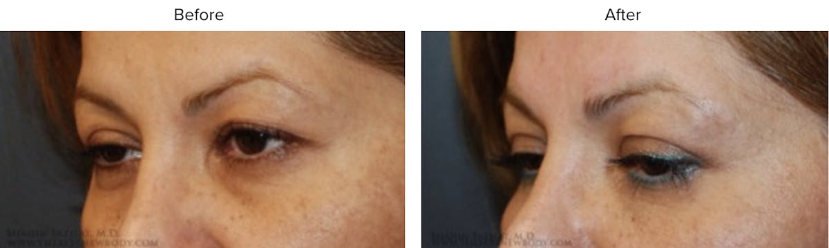 Blepharoplasty (Eyelid Surgery) Before & After Gallery - Patient 258042 - Image 2