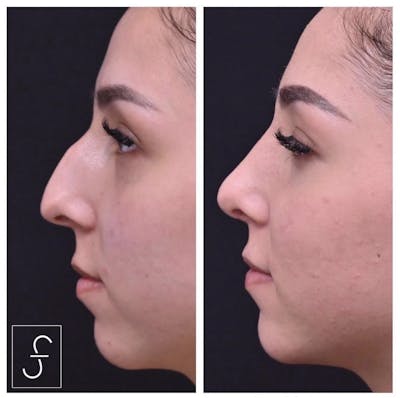 Rhinoplasty (Nose Job) Before & After Gallery - Patient 360053 - Image 1