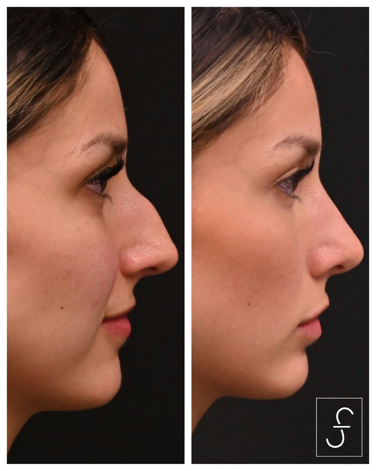 Rhinoplasty (Nose Job) Before & After Gallery - Patient 177348 - Image 1