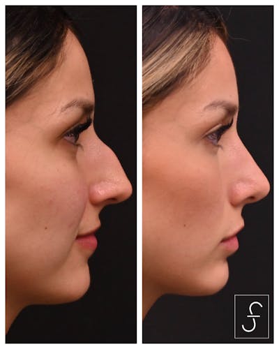 Rhinoplasty (Nose Job) Before & After Gallery - Patient 177348 - Image 1
