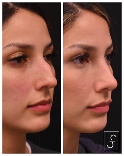 Rhinoplasty (Nose Job) Before & After Gallery - Patient 292422 - Image 1