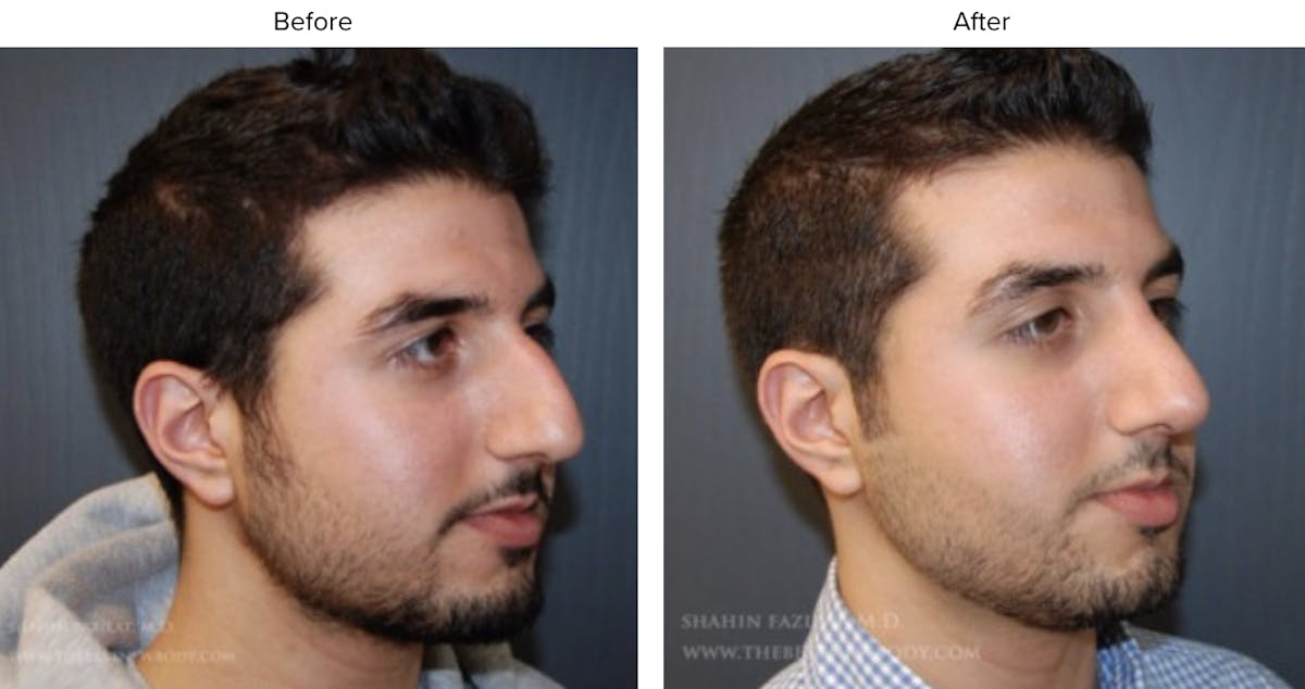 Rhinoplasty (Nose Job) Before & After Gallery - Patient 422513 - Image 2
