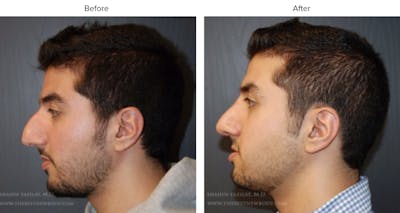 Rhinoplasty (Nose Job) Before & After Gallery - Patient 422513 - Image 1
