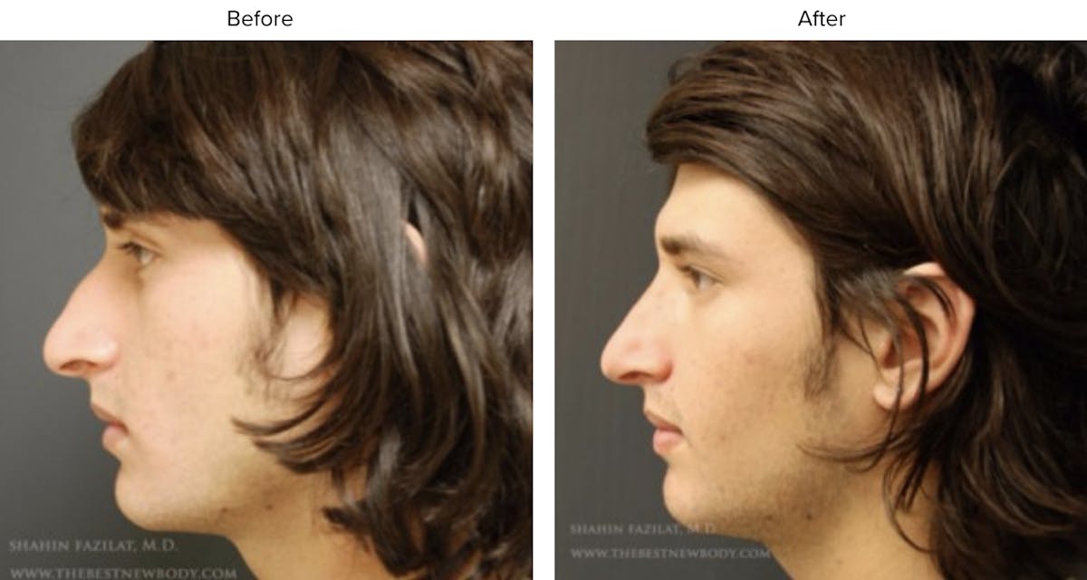 Rhinoplasty (Nose Job) Before & After Gallery - Patient 422996 - Image 2