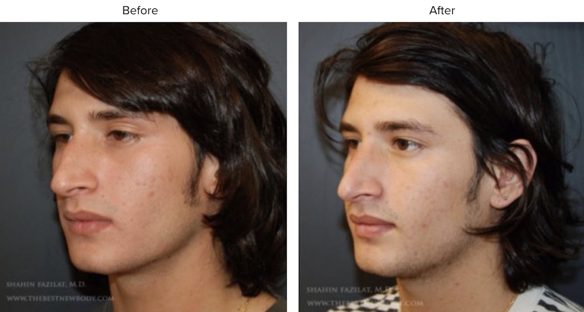 Rhinoplasty (Nose Job) Before & After Gallery - Patient 422996 - Image 1