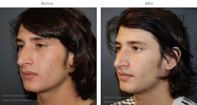 Rhinoplasty (Nose Job) Before & After Gallery - Patient 422996 - Image 1