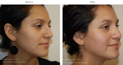 Rhinoplasty (Nose Job) Before & After Gallery - Patient 951271 - Image 1