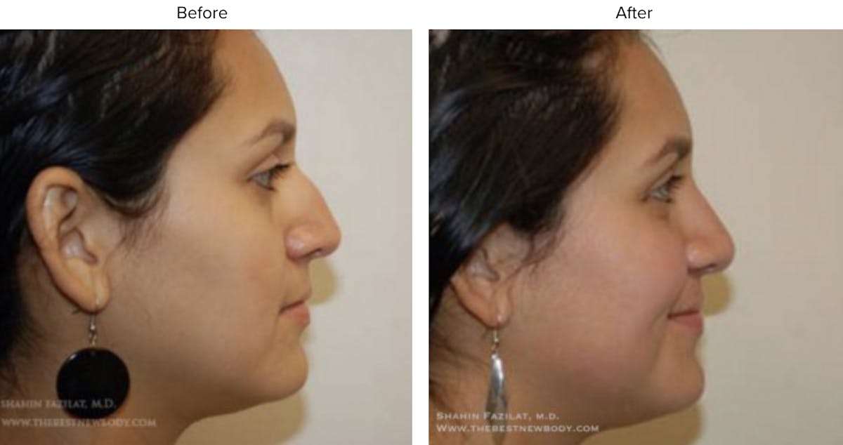 Rhinoplasty (Nose Job) Before & After Gallery - Patient 951271 - Image 2