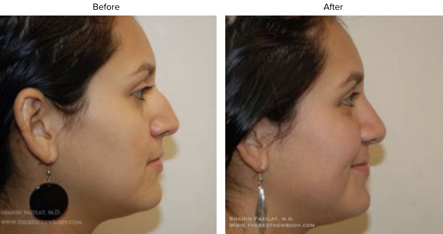 Rhinoplasty (Nose Job) Before & After Gallery - Patient 951271 - Image 2