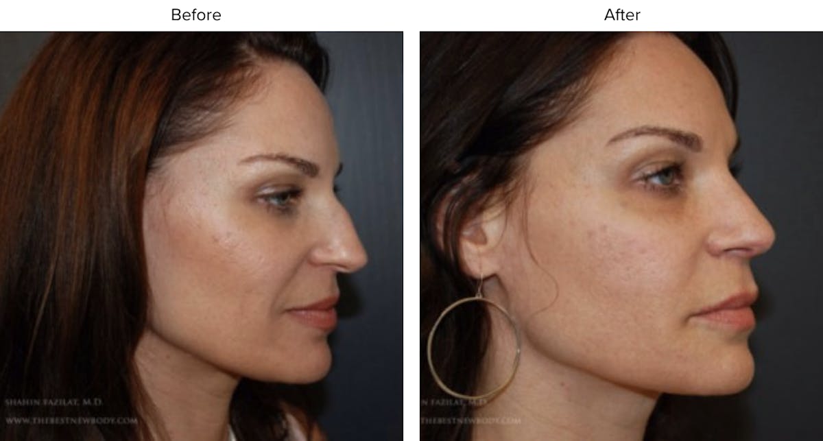 Rhinoplasty (Nose Job) Before & After Gallery - Patient 291838 - Image 1