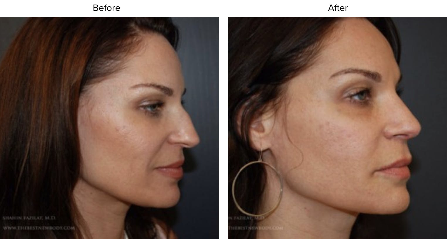 Rhinoplasty (Nose Job) Before & After Gallery - Patient 291838 - Image 1