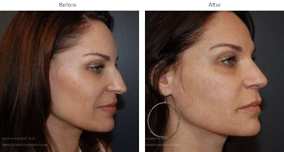 Rhinoplasty (Nose Job) Before & After Gallery - Patient 291838 - Image 1