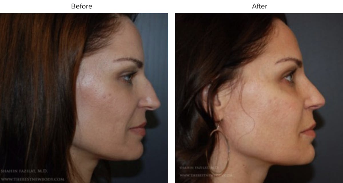 Rhinoplasty (Nose Job) Before & After Gallery - Patient 291838 - Image 2