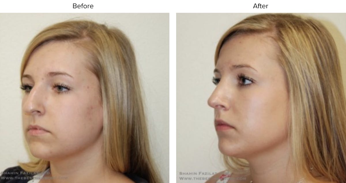 Rhinoplasty (Nose Job) Before & After Gallery - Patient 363116 - Image 1