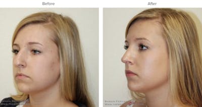 Rhinoplasty (Nose Job) Before & After Gallery - Patient 363116 - Image 1