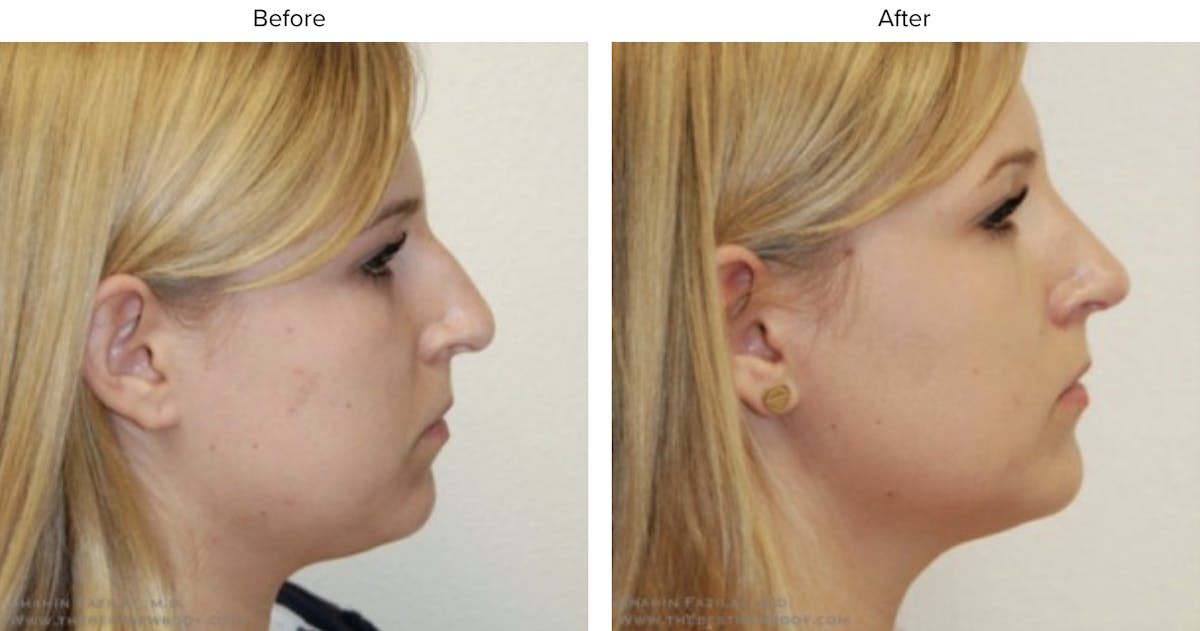 Rhinoplasty (Nose Job) Before & After Gallery - Patient 363116 - Image 2
