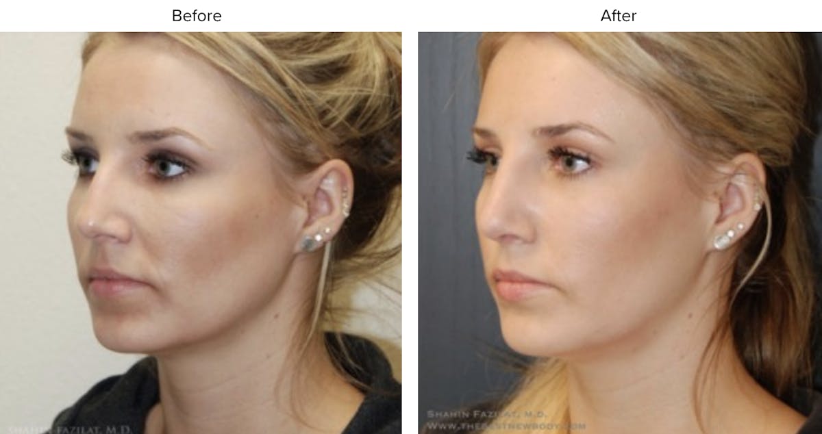Rhinoplasty (Nose Job) Before & After Gallery - Patient 634232 - Image 1