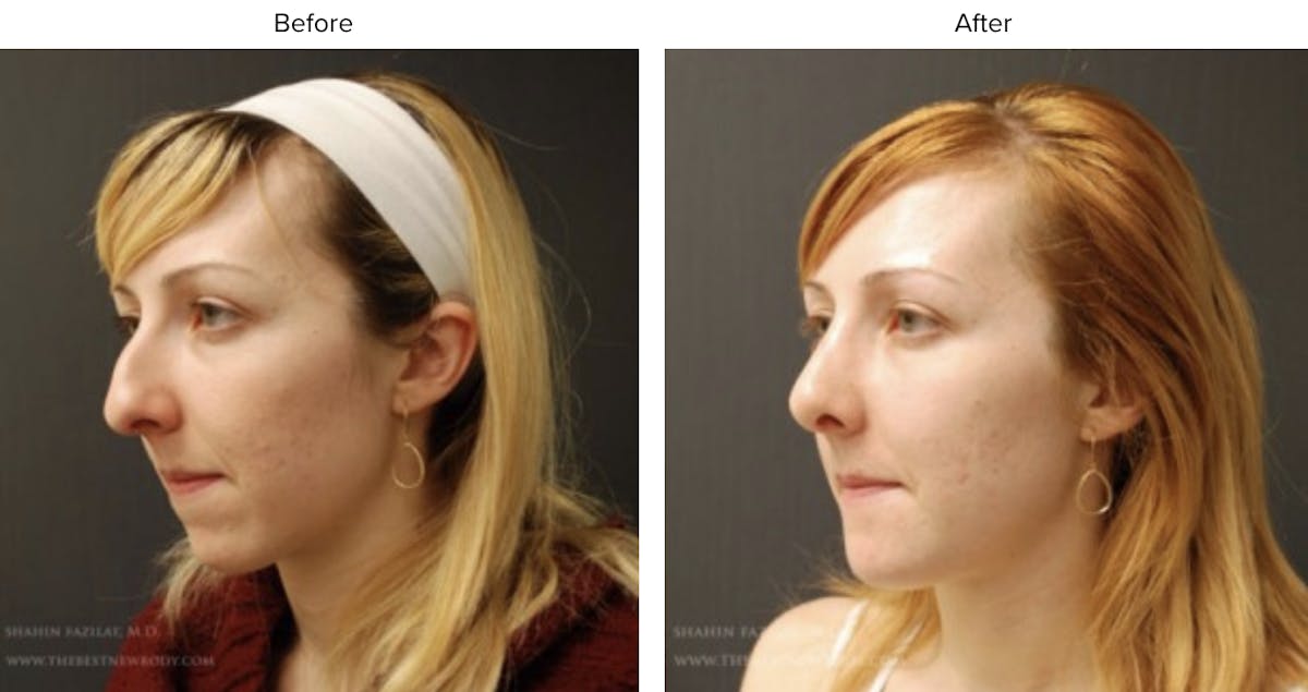 Rhinoplasty (Nose Job) Before & After Gallery - Patient 174896 - Image 1