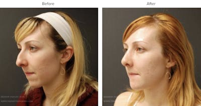 Rhinoplasty (Nose Job) Before & After Gallery - Patient 174896 - Image 1