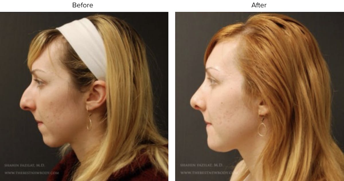 Rhinoplasty (Nose Job) Before & After Gallery - Patient 174896 - Image 2