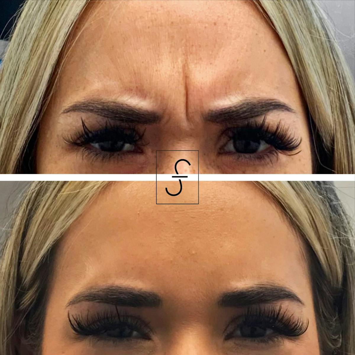 BOTOX Before & After Gallery - Patient 122712 - Image 1