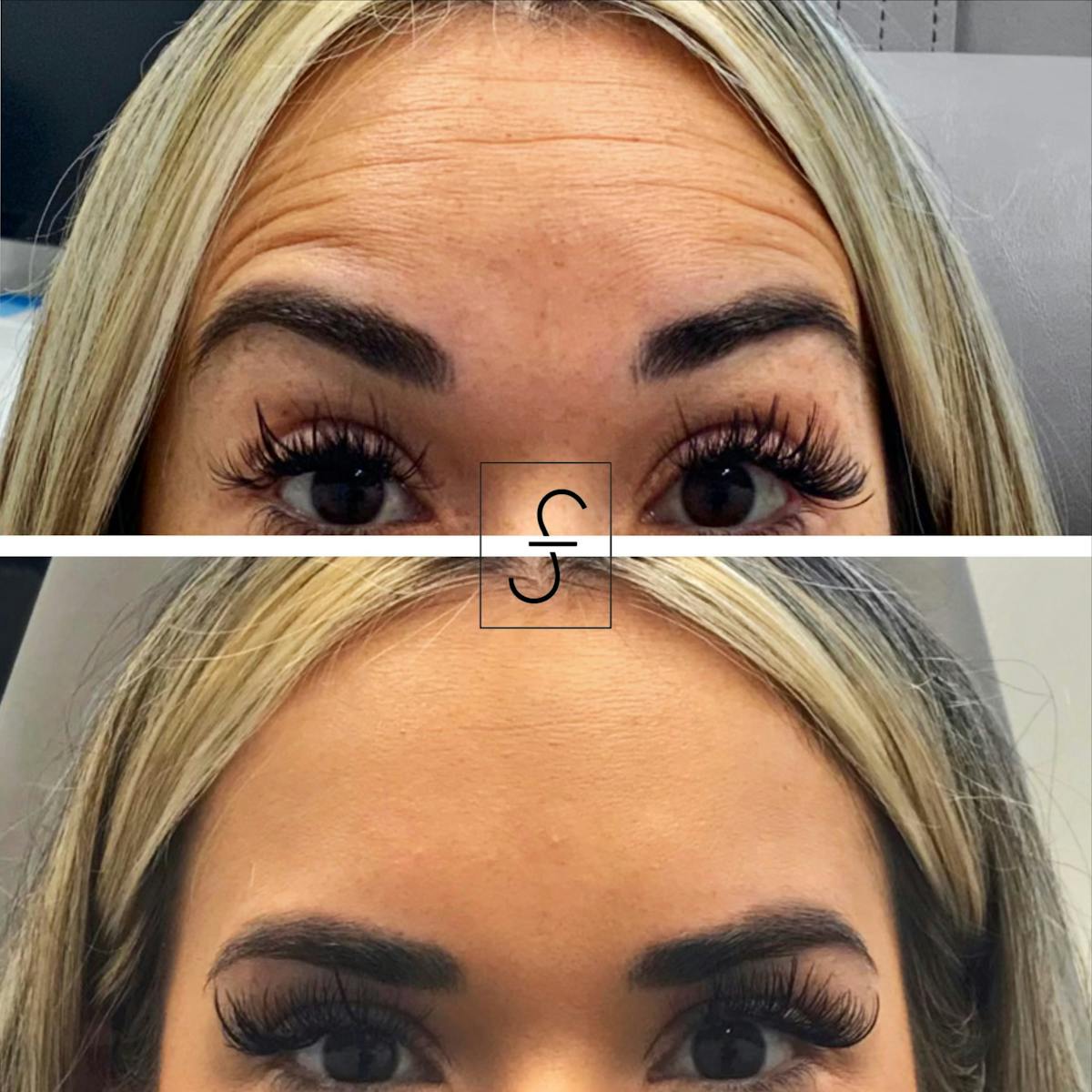 BOTOX Before & After Gallery - Patient 122712 - Image 2