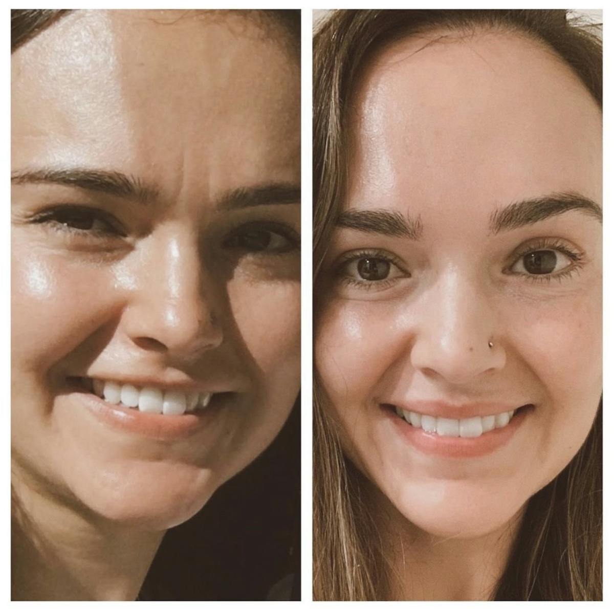 BOTOX Before & After Gallery - Patient 407884 - Image 1