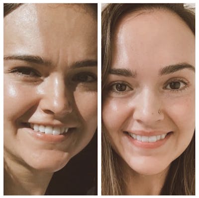 BOTOX Before & After Gallery - Patient 407884 - Image 1