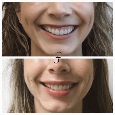 BOTOX Before & After Gallery - Patient 343596 - Image 1