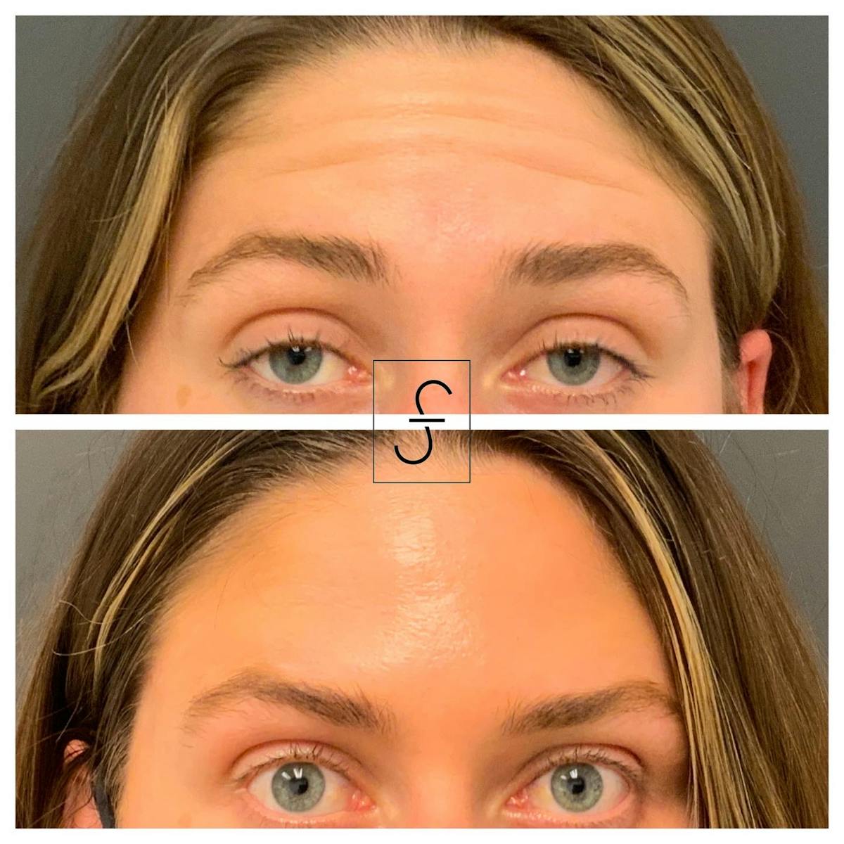 BOTOX Before & After Gallery - Patient 119200 - Image 1