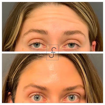 BOTOX Before & After Gallery - Patient 119200 - Image 1