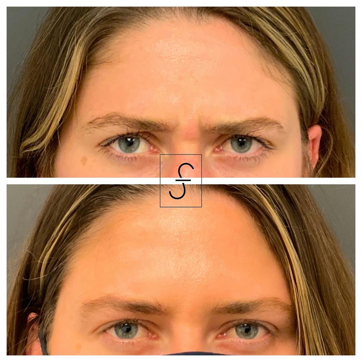 BOTOX Before & After Gallery - Patient 119200 - Image 2