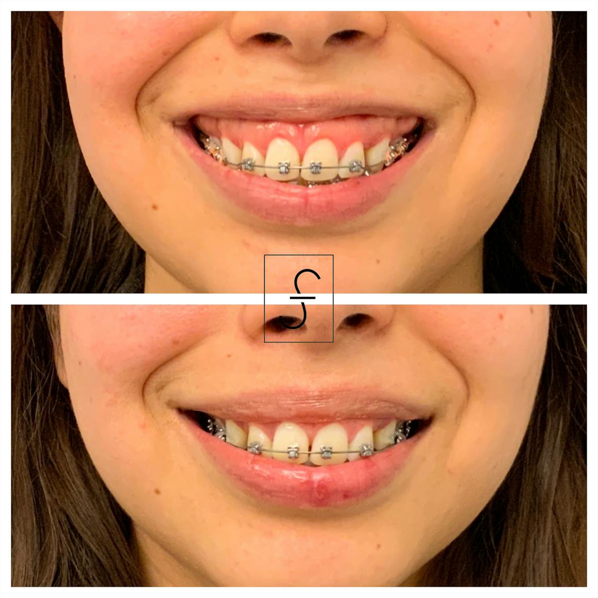 BOTOX Before & After Gallery - Patient 353095 - Image 1