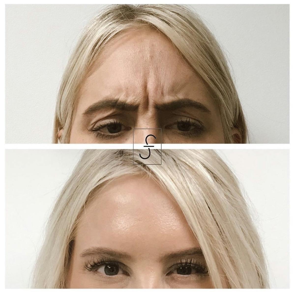 BOTOX Before & After Gallery - Patient 223401 - Image 1