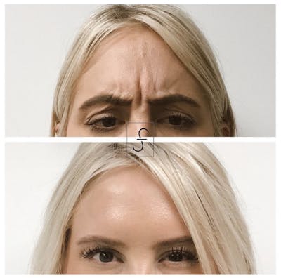 BOTOX Before & After Gallery - Patient 223401 - Image 1