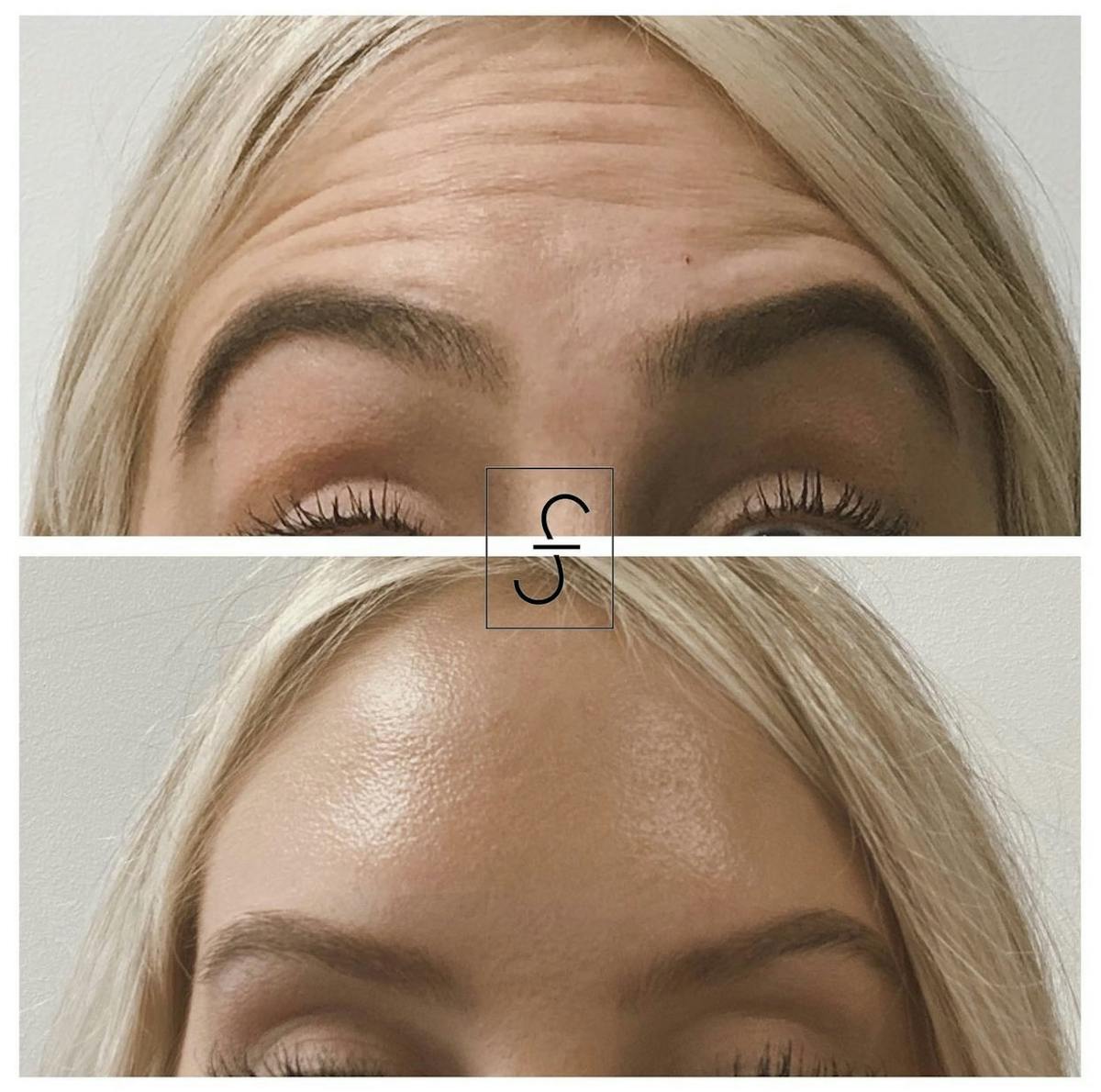 BOTOX Before & After Gallery - Patient 223401 - Image 2