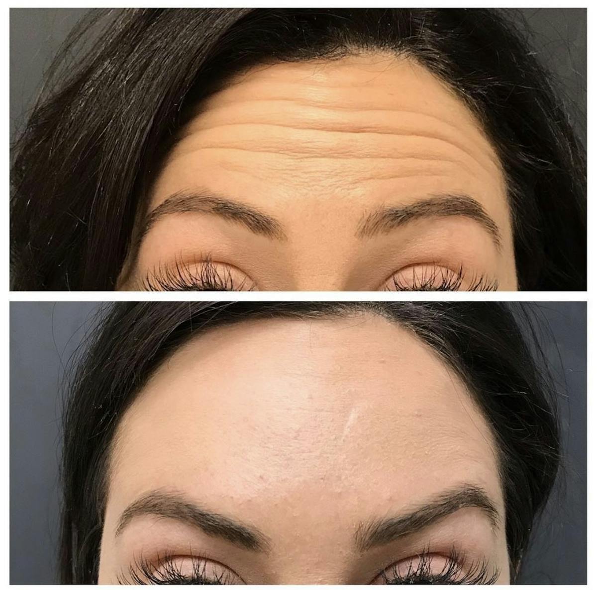 BOTOX Before & After Gallery - Patient 158012 - Image 1