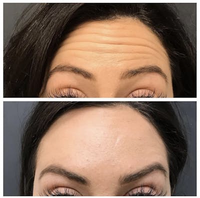 BOTOX Before & After Gallery - Patient 158012 - Image 1