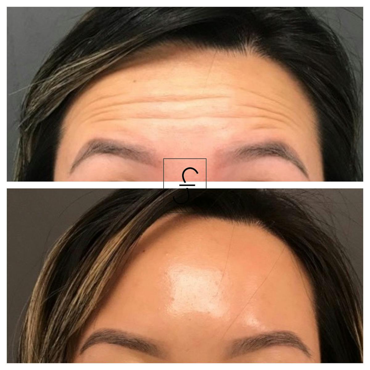 BOTOX Before & After Gallery - Patient 158012 - Image 2