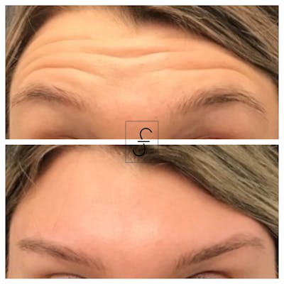 BOTOX Before & After Gallery - Patient 252298 - Image 1